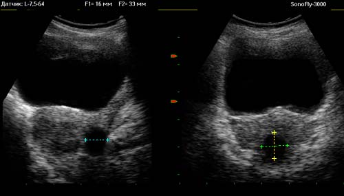 Проведение УЗИ - измерений