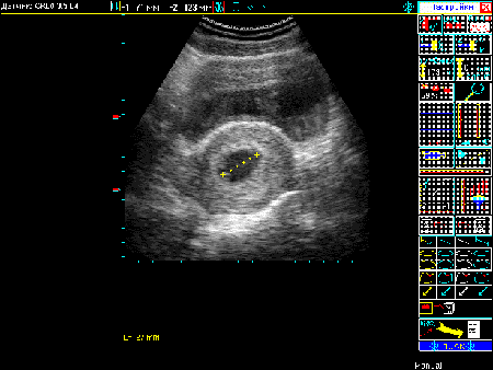 Измерение внутреннего  диаметра плодного яйца 